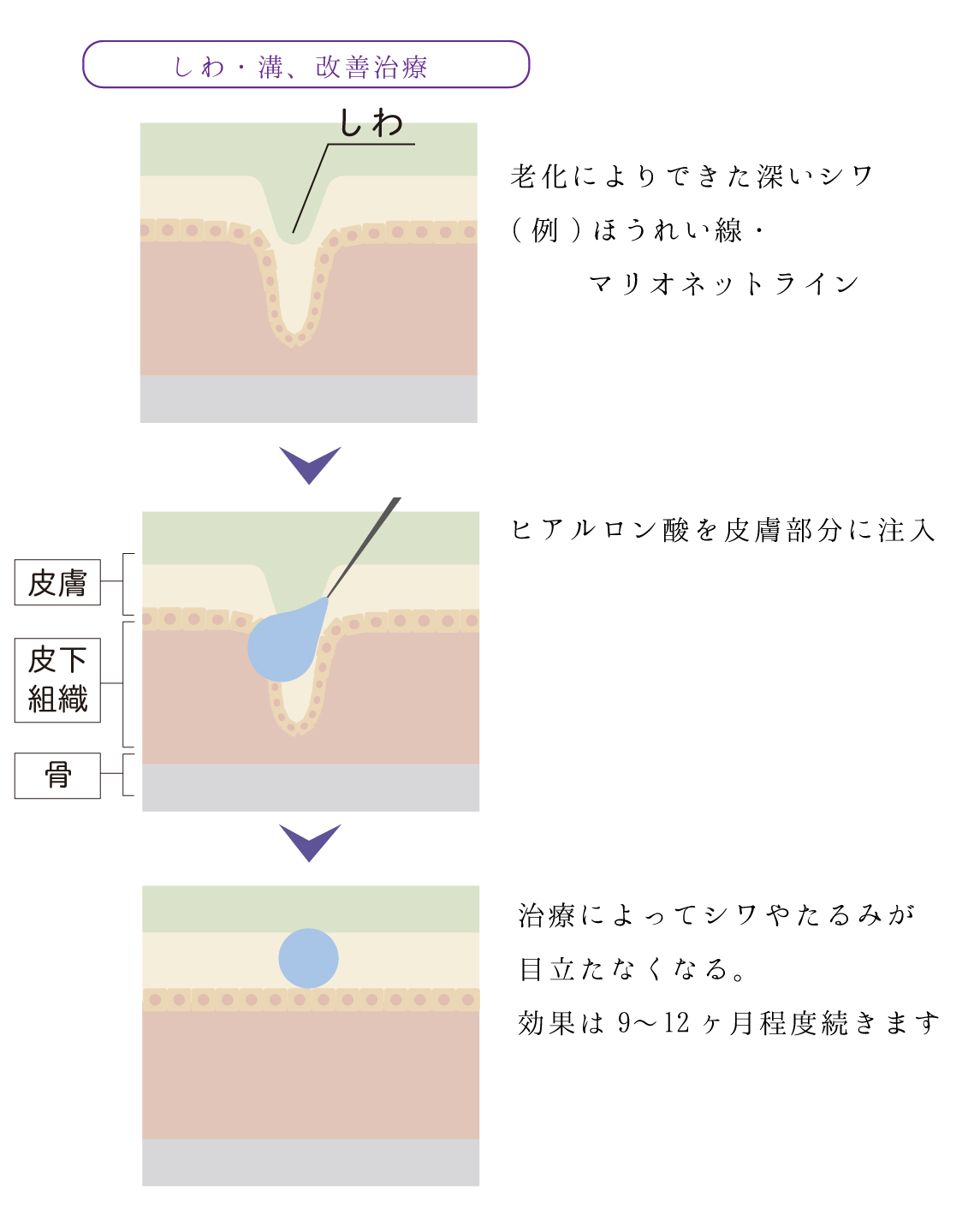 注入方法