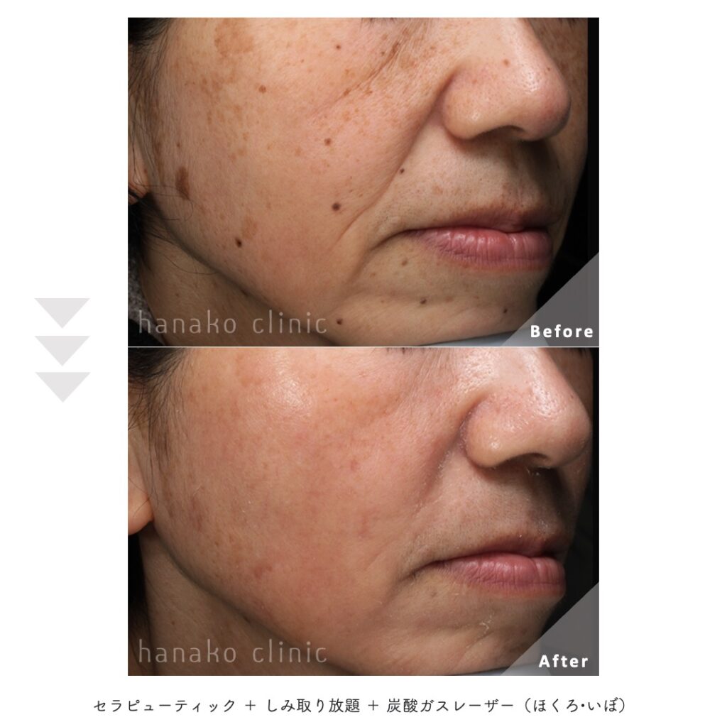 治療前後の肝斑症例写真