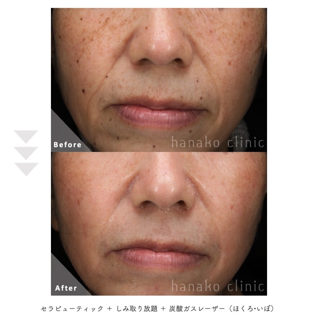 セラピューティック＋シミ取り放題＋CO2レーザーでのほくろいぼ除去症例写真正面