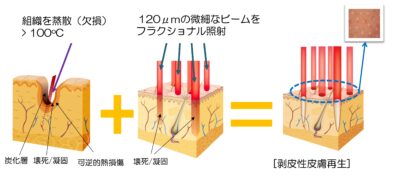 CO2フラクショナル図解