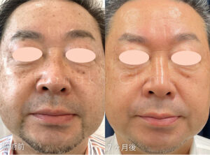 炭酸ガスレーザー イボ取り放題(100個)+ ピコトーニング 7回をした方のビフォーアフター