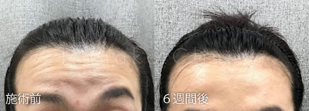 額 ボトックス注射をされた方のビフォーアフター