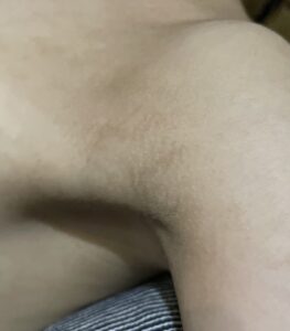 アトピーの痒みが治った後の黒ずんだ脇