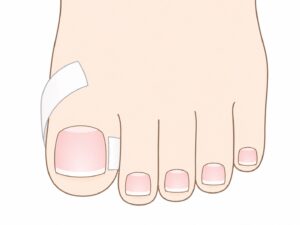テーピング法のイラスト