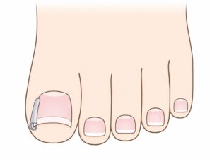 ガター法のイラスト